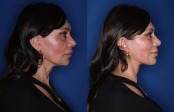 Before and 3-months-after photos of a 59-year-old female patient following KalosLift extended deep plane facelift with platysmaplasty neck lift.