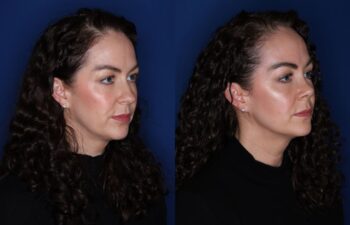 41 year old female 2 months post rhinoplasty