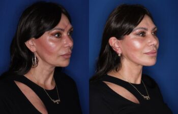 Before and 3-months-after photos of a 59-year-old female patient following KalosLift extended deep plane facelift with platysmaplasty neck lift.