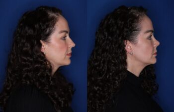 41 year old female 2 months post rhinoplasty