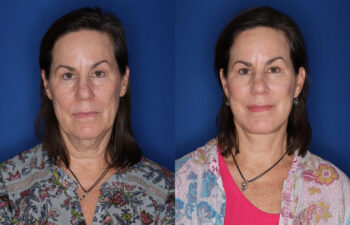 59 year old female before and 5 months after KalosLift extended deep plane facelift with platysmaplasty neck lift procedures