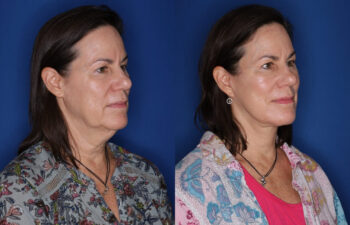 59 year old female before and 5 months after KalosLift extended deep plane facelift with platysmaplasty neck lift procedures