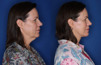 59 year old female before and 5 months after KalosLift extended deep plane facelift with platysmaplasty neck lift procedures