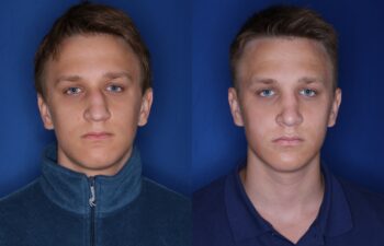 16 year old male 5 months post rhinoplasty