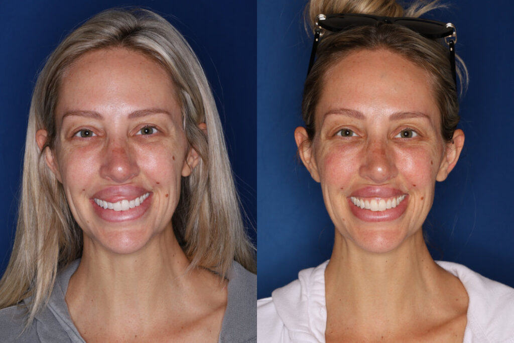 front before and after photo of 34 year old female 1 month post upper lip reduction