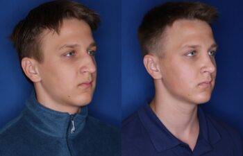 16 year old male 5 months post rhinoplasty