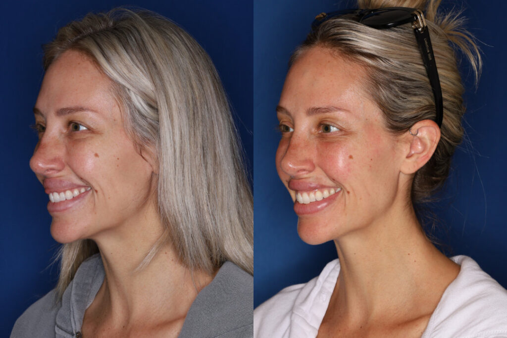 left side before and after photo of 34 year old female 1 month post upper lip reduction