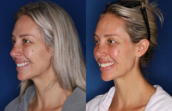 left side before and after photo of 34 year old female 1 month post upper lip reduction