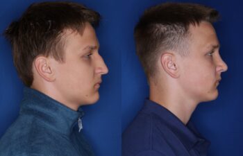 16 year old male 5 months post rhinoplasty