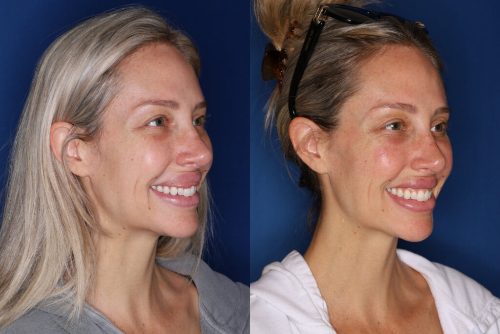 right side before and after photo of 34 year old female 1 month post upper lip reduction