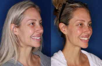 right side before and after photo of 34 year old female 1 month post upper lip reduction
