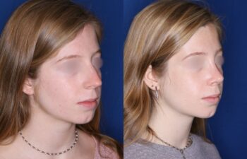 Before and after photos of a 19-year-old female, 4 months after rhinoplasty performed by Kalos Plastic Surgery, showing nose profile improvement, left oblique view.
