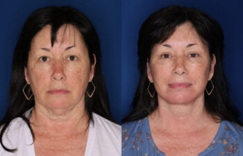 Before and after results of a 62-year-old woman, 4 months after upper eyelid surgery, deep plane facelift, and platysmaplasty neck lift, front.