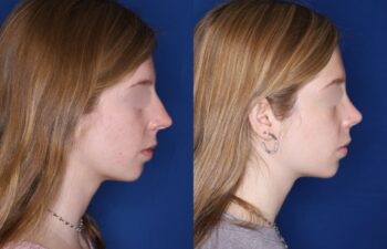 Before and after photos of a 19-year-old female, 4 months after rhinoplasty performed by Kalos Plastic Surgery, showing nose profile improvement, left side.