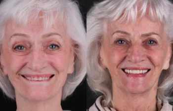 85 year old female 2 months post upper lip reduction and lower lip direct lip lift