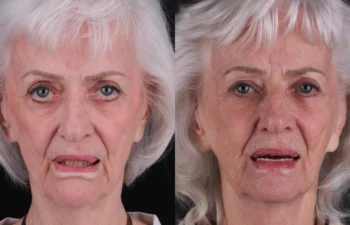 85 year old female 2 months post upper lip reduction and lower lip direct lip lift
