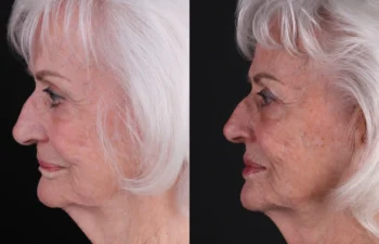 85 year old female 2 months post upper lip reduction and lower lip direct lip lift