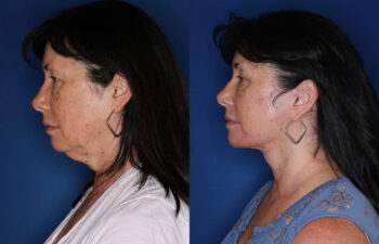 Before and after results of a 62-year-old woman, 4 months after upper eyelid surgery, deep plane facelift, and platysmaplasty neck lift, left side.