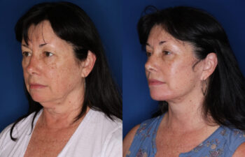 Before and after results of a 62-year-old woman, 4 months after upper eyelid surgery, deep plane facelift, and platysmaplasty neck lift, left oblique view.