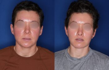 37 year old female 4 months post buccal fat removal, perialar lip lift, and KalosLift extended deep plane facelift with platysmaplasty neck lift