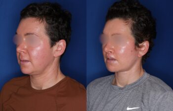 37 year old female 4 months post buccal fat removal, perialar lip lift, and KalosLift extended deep plane facelift with platysmaplasty neck lift