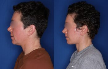 37 year old female 4 months post buccal fat removal, perialar lip lift, and KalosLift extended deep plane facelift with platysmaplasty neck lift