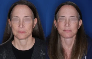 53 year old female 6 months post fat transposition lower blepharoplasty and KalosLift extended deep plane facelift with platysmaplasty neck lift