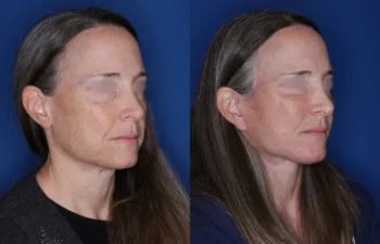 53 year old female 6 months post fat transposition lower blepharoplasty and KalosLift extended deep plane facelift with platysmaplasty neck lift