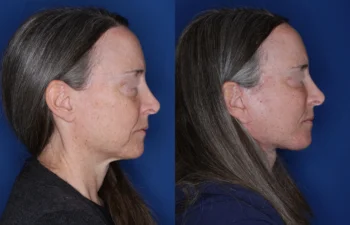 53 year old female 6 months post fat transposition lower blepharoplasty and KalosLift extended deep plane facelift with platysmaplasty neck lift