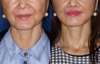 Side-by-side comparison of a woman's lower face and neck before (left) and after (right) a cosmetic procedure, showing smoother skin and fuller lips in the after image.