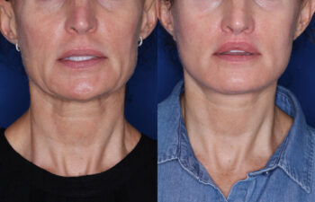 51 year old female 4 months post KalosLift extended deep plane facelift with platysmaplasty neck lift and Perialar Lip Lift