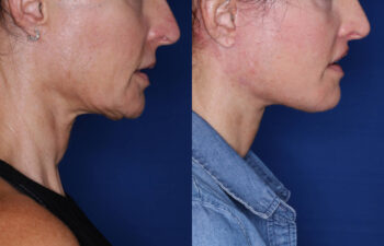 51 year old female 4 months post KalosLift extended deep plane facelift with platysmaplasty neck lift and Perialar Lip Lift