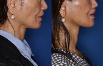 Side-by-side profile photos of a woman before and after a cosmetic procedure, showing changes in jawline and facial contour against a blue background.