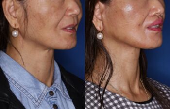 Side-by-side comparison of a woman's face before and after a cosmetic procedure, showing changes in skin texture and jawline definition.