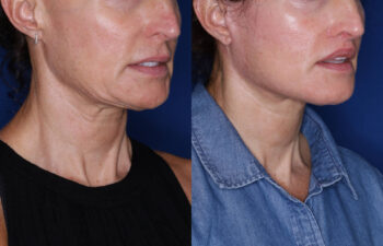 51 year old female 4 months post KalosLift extended deep plane facelift with platysmaplasty neck lift and Perialar Lip Lift