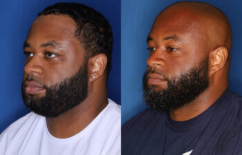 47 year old male 4 months post upper/lower lip reduction