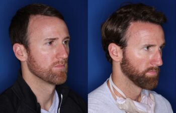 36 year old 8 months following 2500 grafts to frontal, temporal hair line