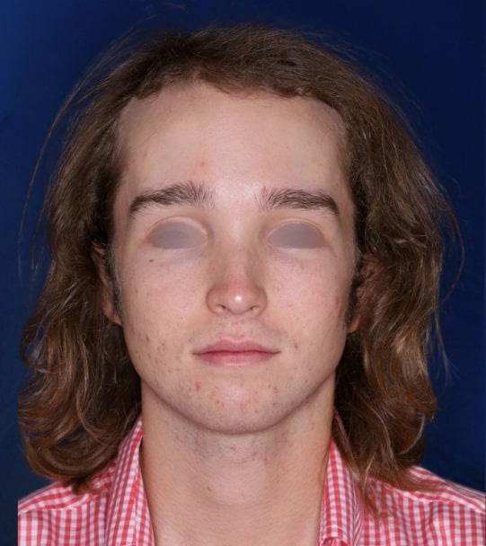 25 year old male about 2 years following 1,500 graft transplant