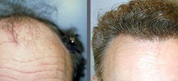 Before and after one hair transplant using the follicular unit extraction method of hair transplantation with NeoGraft, one session of 3000 hair grafts.