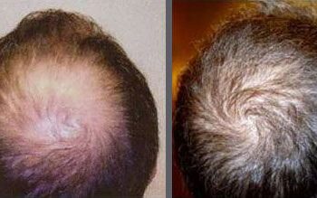 Before and after one hair transplant using the follicular unit extraction method of hair transplantation with NeoGraft, one session of 2000 hair grafts.