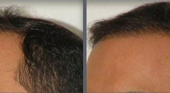 Time elapse of hair transplant session using grafts by follicular grafting using the thin strip method.