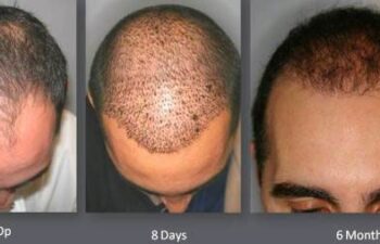 Time elapse of male hair transplant using NeoGraft.