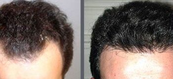 Before and after one hair transplant using the follicular unit extraction method of hair transplantation with NeoGraft, one session of 1500 hair grafts.