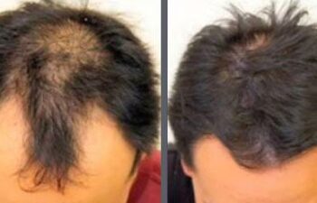 Before and after one hair transplant using the follicular unit extraction method of hair transplantation with NeoGraft, one session of 2000 hair grafts.