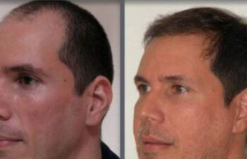 Before and after one hair transplant using the follicular unit extraction method of hair transplantation with NeoGraft, one session of 2000 hair grafts.