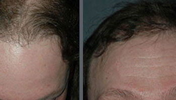 Before and after one hair transplant session of 1000 grafts by follicular grafting using the thin strip method.
