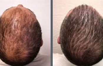 Before and after one hair transplant using the follicular unit extraction method of hair transplantation with NeoGraft, one session of 2000 hair grafts.