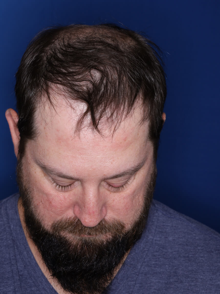 45 year old male 1 year post op from 3000 grafts throughout the entire scalp.