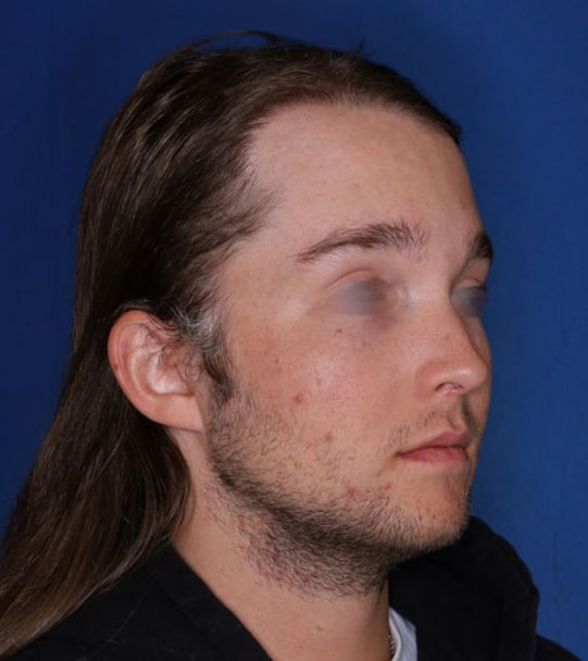 25 year old male about 2 years following 1,500 graft transplant