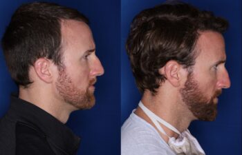 36 year old 8 months following 2500 grafts to frontal, temporal hair line